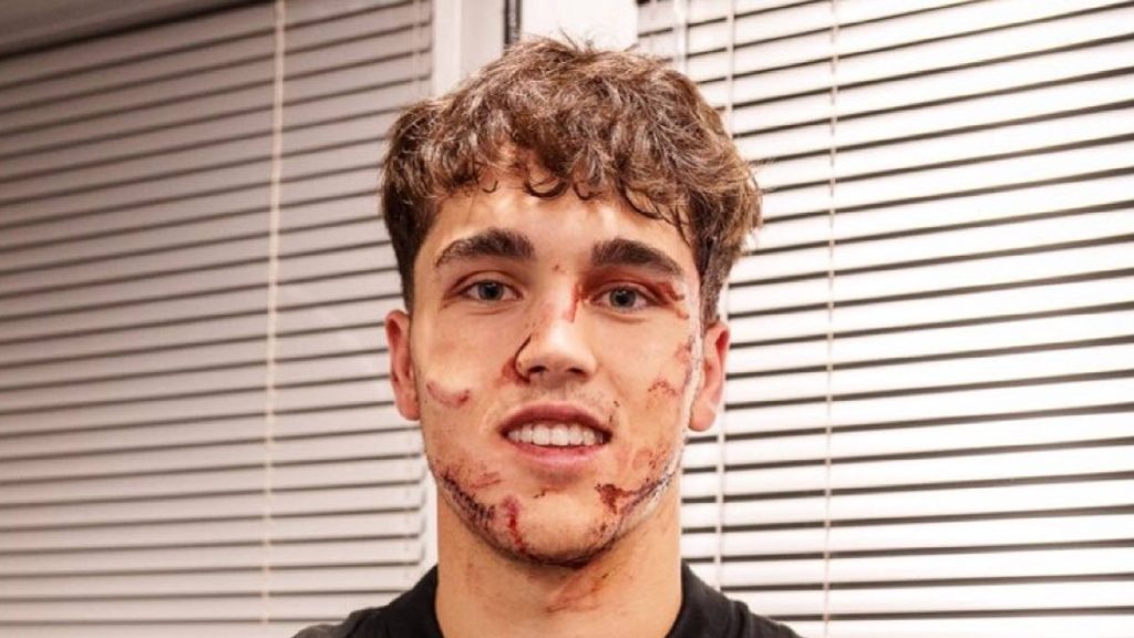 Tonggak Barcelona Terima 10 Jahitan Di Muka